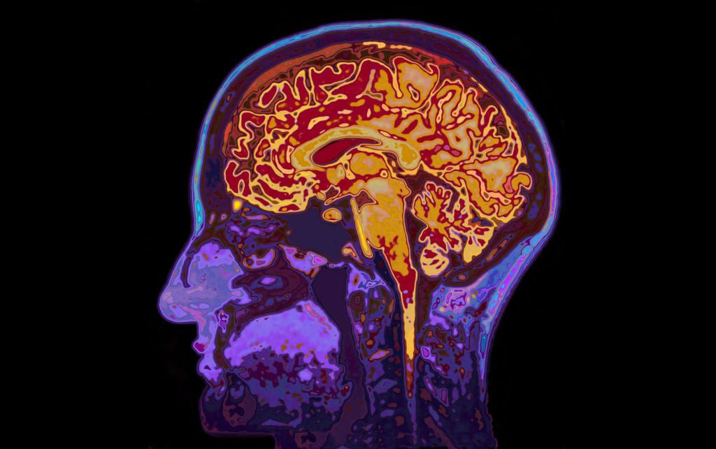 Reduce and Manage Stress - Brain scan